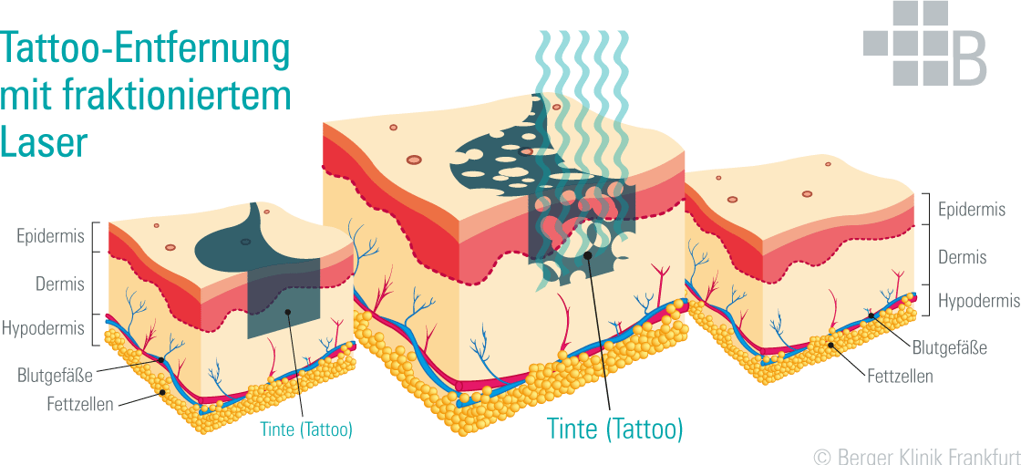 Grafik für Tattoo-Entfernung mit einem fraktionierten Laser bei Berger Klinik Beauty. Drei Ausschnitte von Hautpartien. Mit Tinte (Tätowierung) vor der Behandlung. Einwirkung von Laserwellen auf die Farbpigmente. Tattoofreie Haut nach der Behandlung.