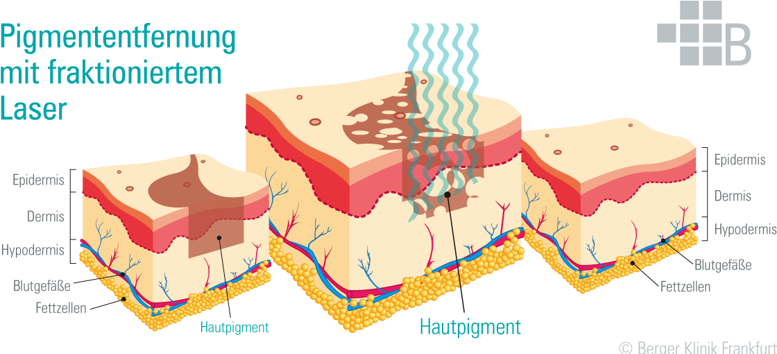 Eine Grafik für Entfernung von Pigment- oder Altersflecken mit einem fraktionierten Laser. Drei Ausschnitte von Hautpartien. Mit Pigmentstörung vor der Behandlung. Die Einwirkung von Laserwellen auf Hautpigmente. Pigmentfreie Haut nach der Behandlung.