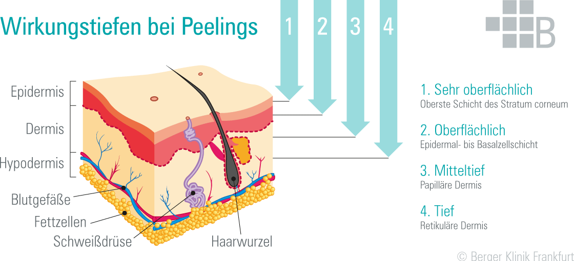 Funktionale Grafik zur Visualisierung von Hautpeelings während Schönheitsbehandlungen bei Berger Beauty in Frankfurt. Die Wirkungstiefe von Fruchtsäure-Peelings wird in vier Stufen eingeordnet: sehr oberflächlich, oberflächlich, mitteltief und tief.